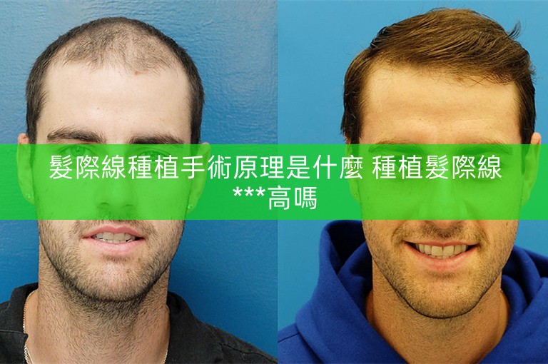 髮際線種植手術原理是什麼 種植髮際線***高嗎 髮際線種植手術原理是什麼 種植髮際線***高嗎