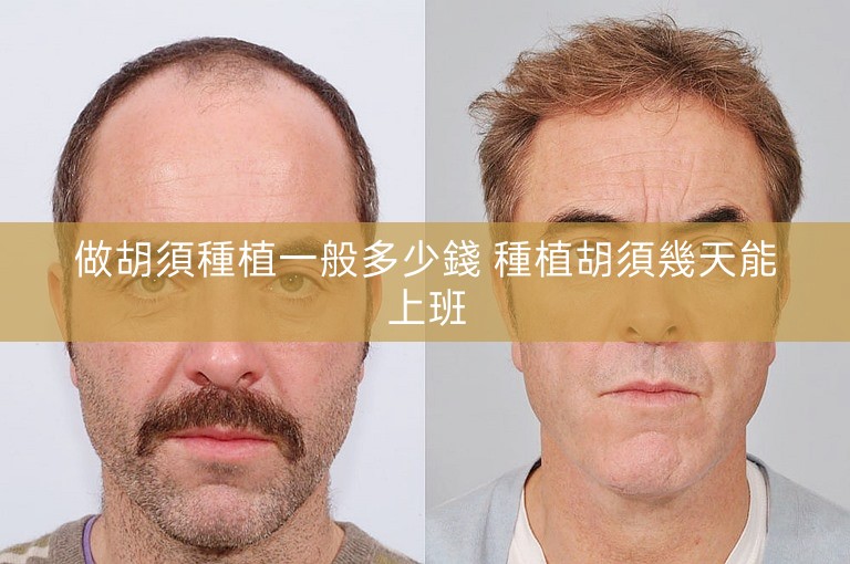 做胡須種植一般多少錢 種植胡須幾天能上班