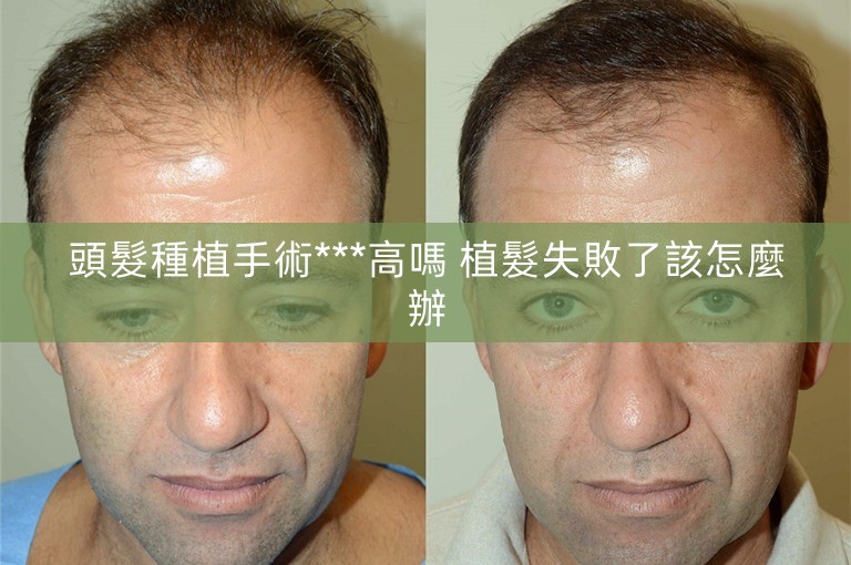 頭髮種植手術***高嗎 植髮失敗了該怎麼辦 頭髮種植手術***高嗎 植髮失敗了該怎麼辦