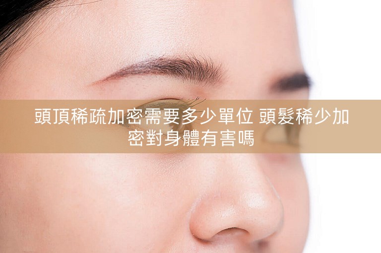 頭頂稀疏加密需要多少單位 頭髮稀少加密對身體有害嗎
