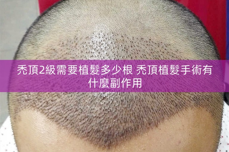 禿頂2級需要植髮多少根 禿頂植髮手術有什麼副作用