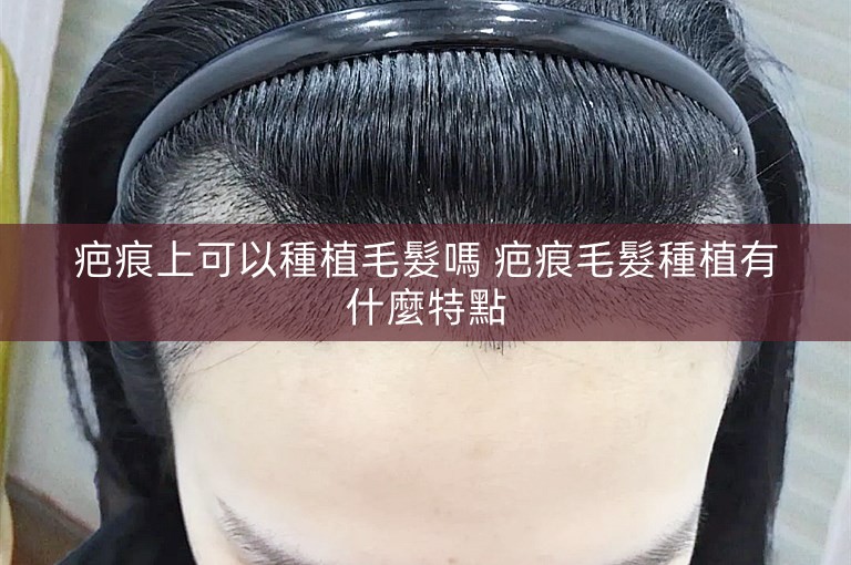 疤痕上可以種植毛髮嗎 疤痕毛髮種植有什麼特點 疤痕上可以種植毛髮嗎 疤痕毛髮種植有什麼特點