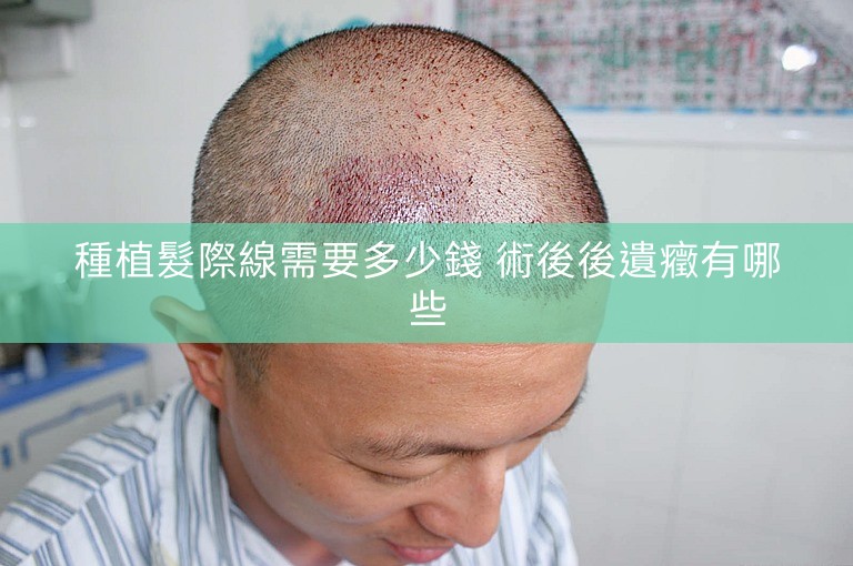 種植髮際線需要多少錢 術後後遺癥有哪些
