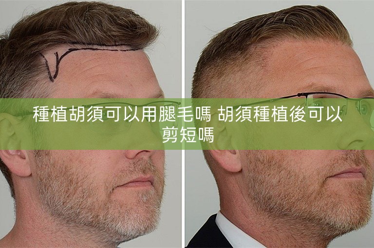 種植胡須可以用腿毛嗎 胡須種植後可以剪短嗎