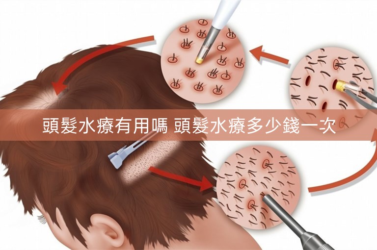 頭髮水療有用嗎 頭髮水療多少錢一次