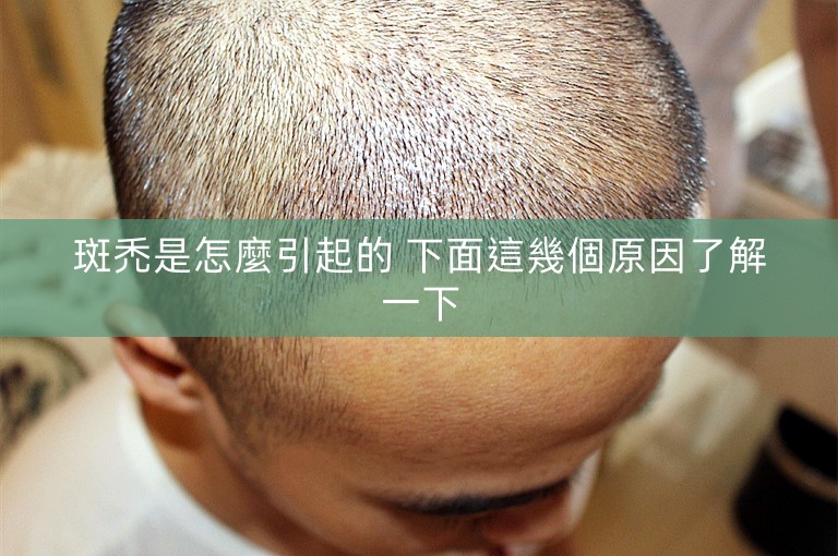 斑禿是怎麼引起的 下面這幾個原因了解一下