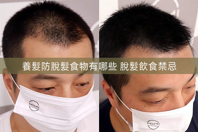 養髮防脫髮食物有哪些 脫髮飲食禁忌
