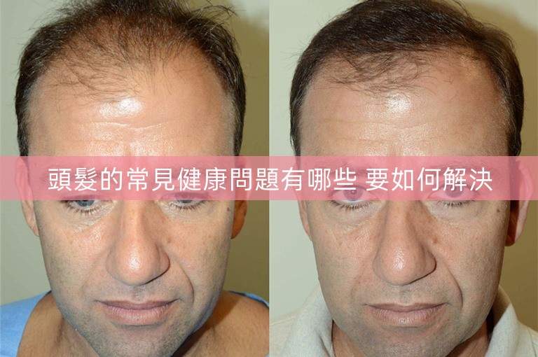 頭髮的常見健康問題有哪些 要如何解決