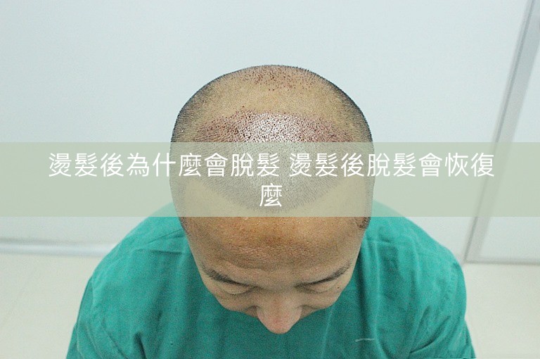 燙髮後為什麼會脫髮 燙髮後脫髮會恢復麼