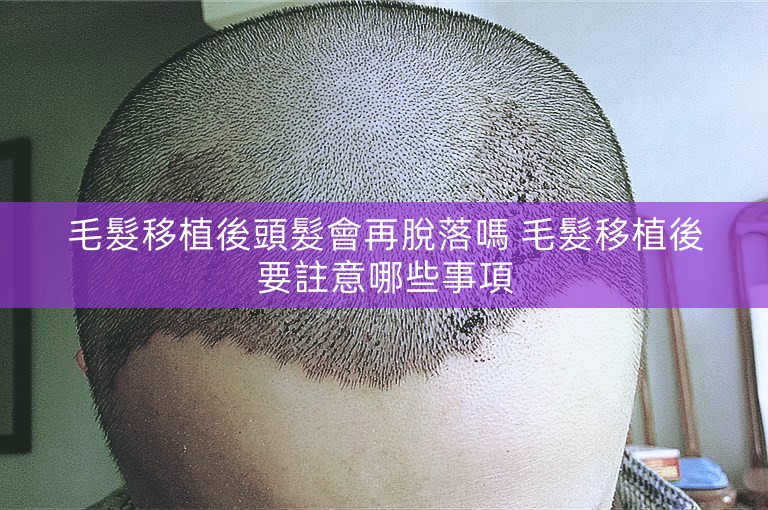 毛髮移植後頭髮會再脫落嗎 毛髮移植後要註意哪些事項