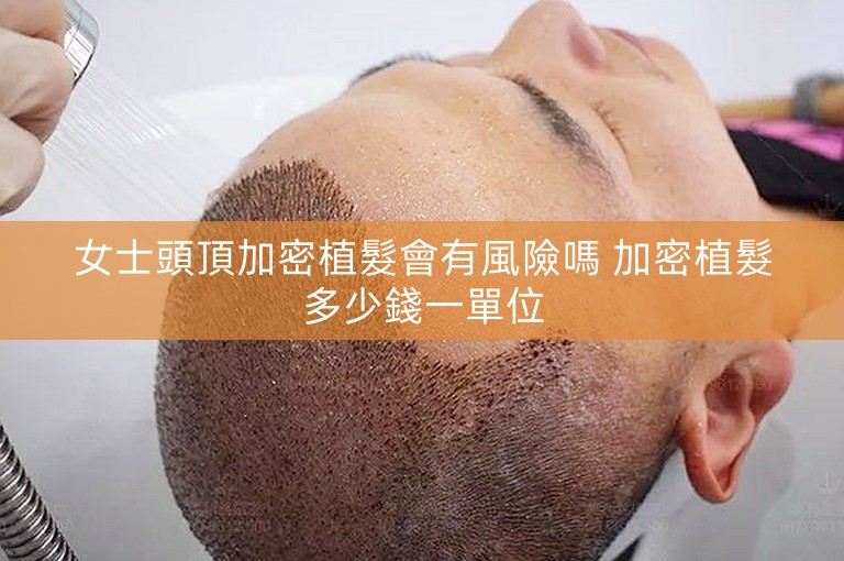 女士頭頂加密植髮會有風險嗎 加密植髮多少錢一單位 女士頭頂加密植髮會有風險嗎 加密植髮多少錢一單位