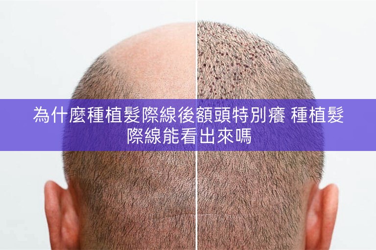為什麼種植髮際線後額頭特別癢 種植髮際線能看出來嗎