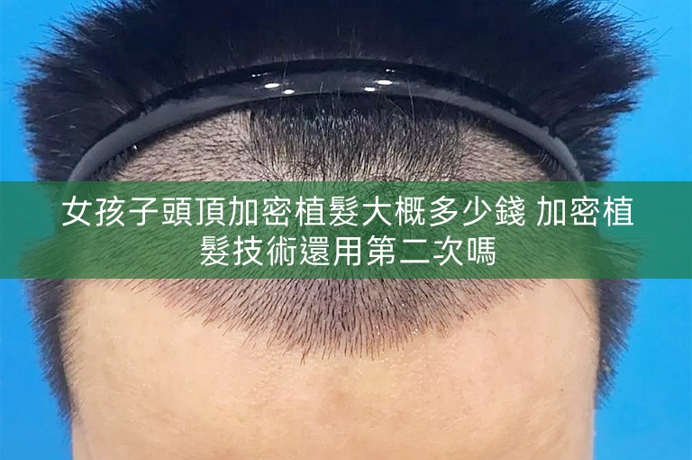 女孩子頭頂加密植髮大概多少錢 加密植髮技術還用第二次嗎