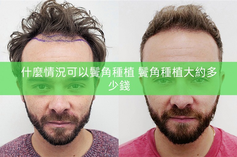 什麼情況可以鬢角種植 鬢角種植大約多少錢