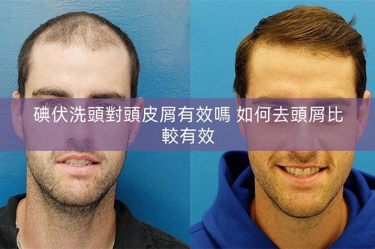 碘伏洗頭對頭皮屑有效嗎 如何去頭屑比較有效