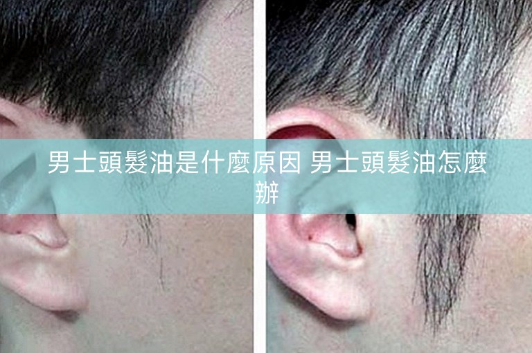 男士頭髮油是什麼原因 男士頭髮油怎麼辦