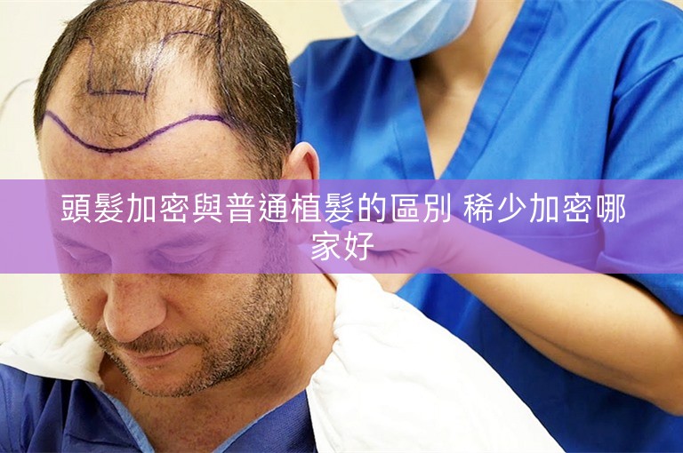 頭髮加密與普通植髮的區別 稀少加密哪家好