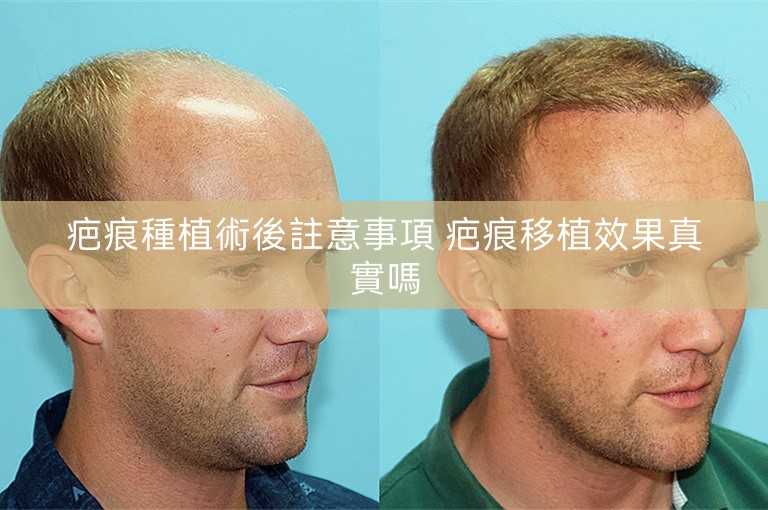 疤痕種植術後註意事項 疤痕移植效果真實嗎