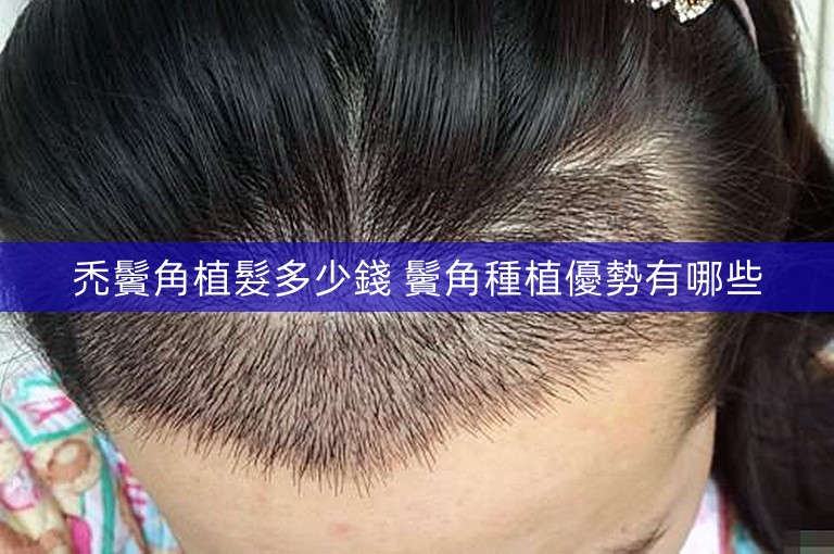 禿鬢角植髮多少錢 鬢角種植優勢有哪些