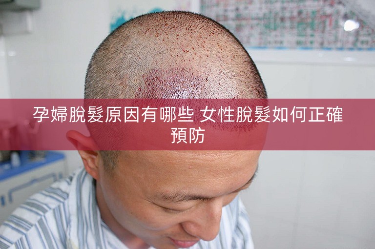孕婦脫髮原因有哪些 女性脫髮如何正確預防