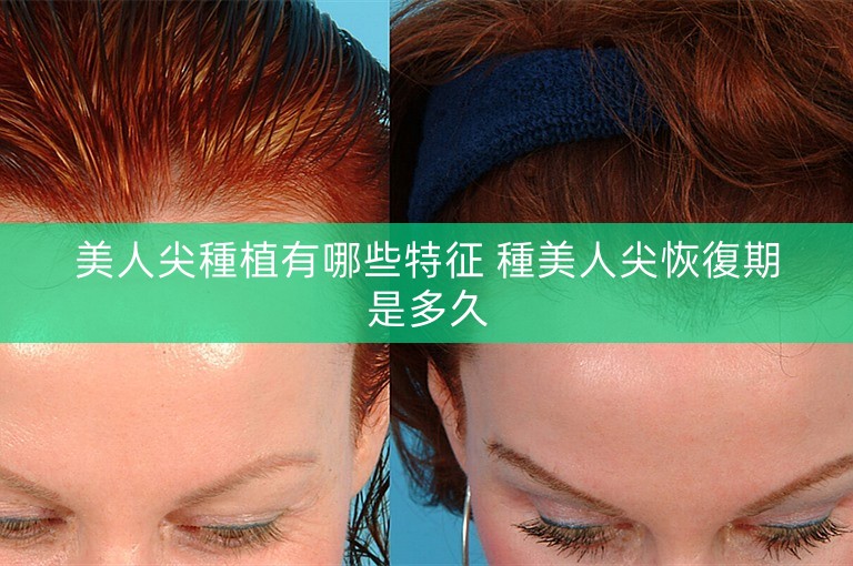 美人尖種植有哪些特征 種美人尖恢復期是多久