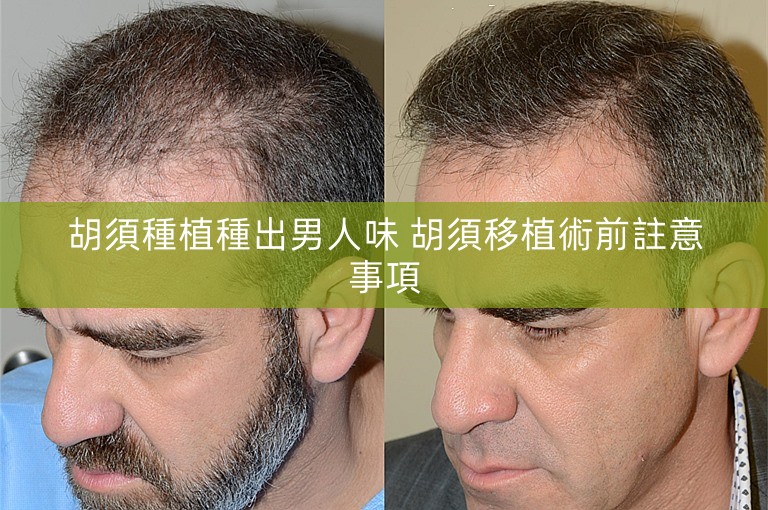 胡須種植種出男人味 胡須移植術前註意事項 胡須種植種出男人味 胡須移植術前註意事項