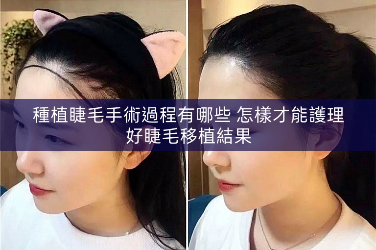種植睫毛手術過程有哪些 怎樣才能護理好睫毛移植結果 種植睫毛手術過程有哪些 怎樣才能護理好睫毛移植結果
