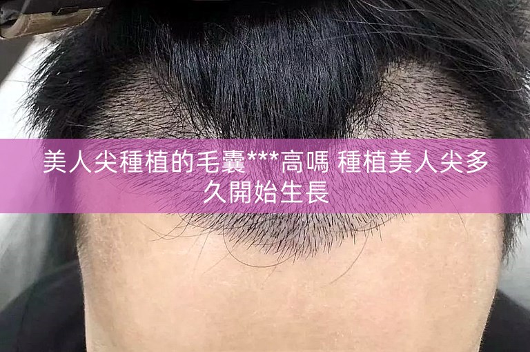 美人尖種植的毛囊***高嗎 種植美人尖多久開始生長