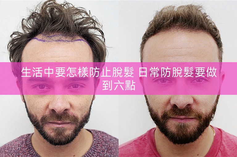 生活中要怎樣防止脫髮 日常防脫髮要做到六點