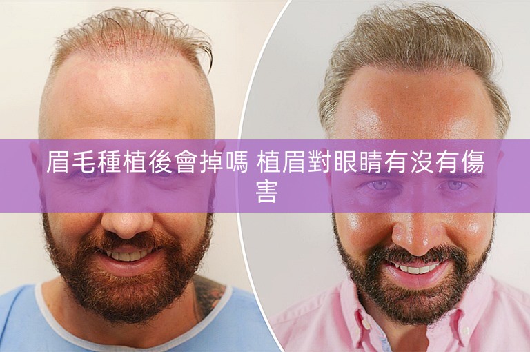 眉毛種植後會掉嗎 植眉對眼睛有沒有傷害