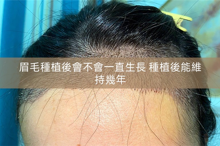 眉毛種植後會不會一直生長 種植後能維持幾年
