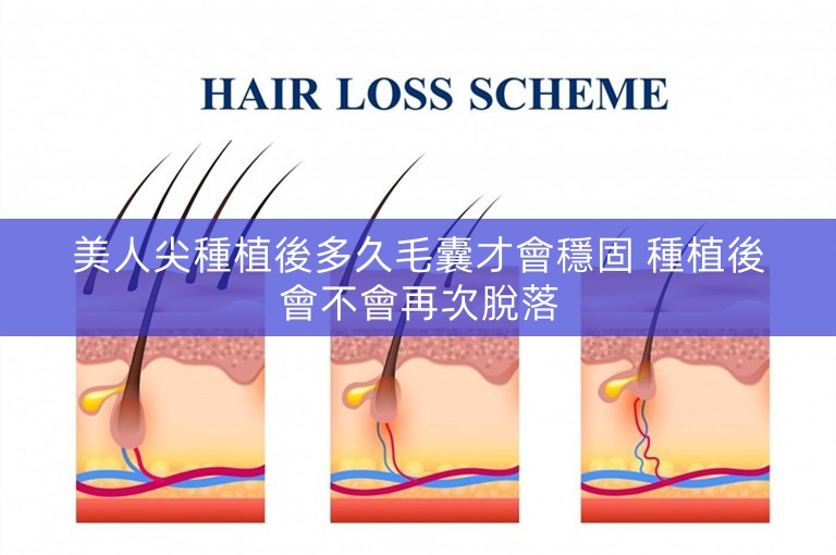 美人尖種植後多久毛囊才會穩固 種植後會不會再次脫落