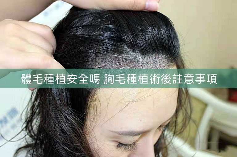 體毛種植安全嗎 胸毛種植術後註意事項