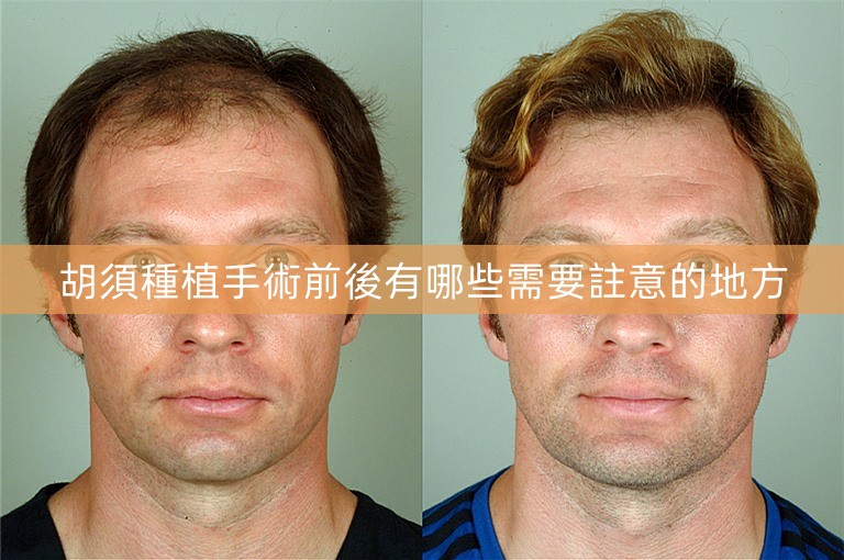 胡須種植手術前後有哪些需要註意的地方 胡須種植手術前後有哪些需要註意的地方