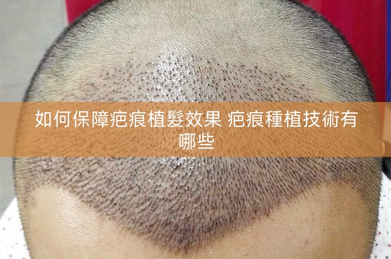 如何保障疤痕植髮效果 疤痕種植技術有哪些
