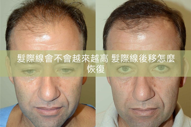 髮際線會不會越來越高 髮際線後移怎麼恢復