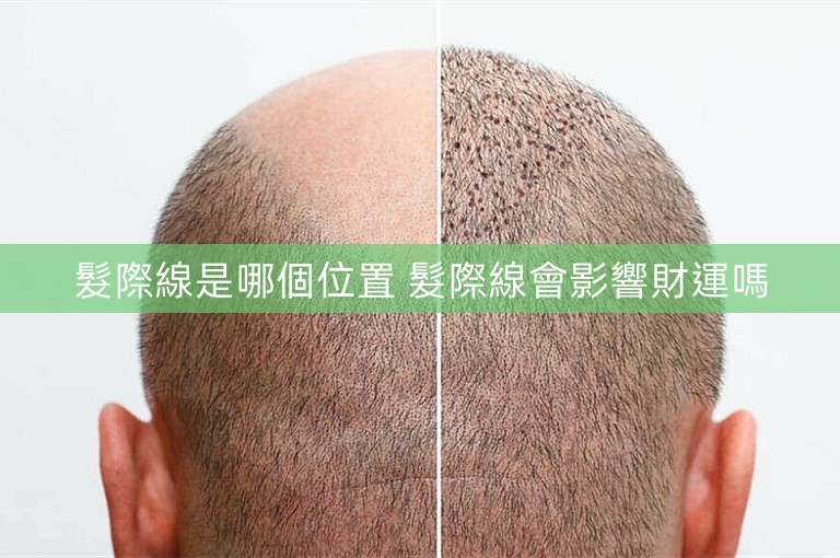 髮際線是哪個位置 髮際線會影響財運嗎