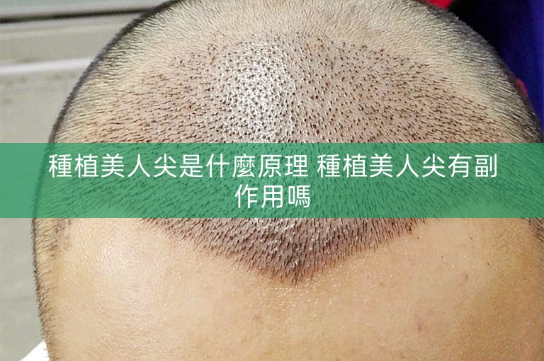 種植美人尖是什麼原理 種植美人尖有副作用嗎