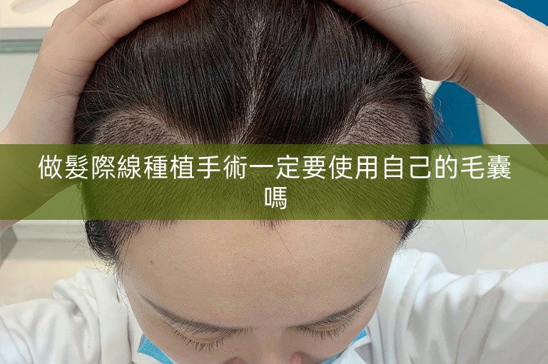 做髮際線種植手術一定要使用自己的毛囊嗎
