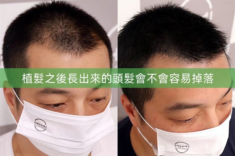 植髮之後長出來的頭髮會不會容易掉落