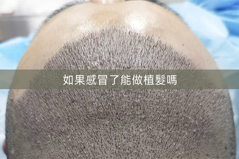 如果感冒了能做植髮嗎