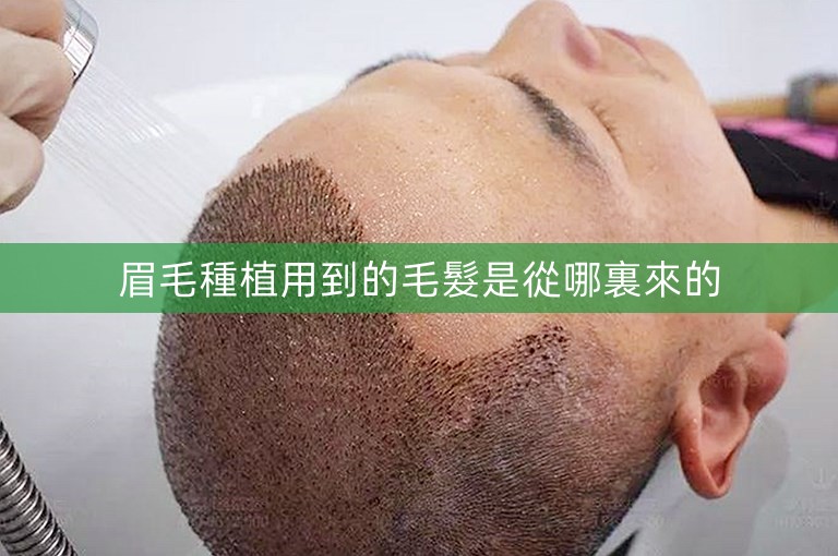 眉毛種植用到的毛髮是從哪裏來的