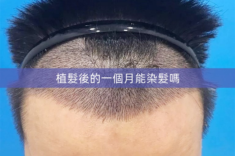 植髮後的一個月能染髮嗎