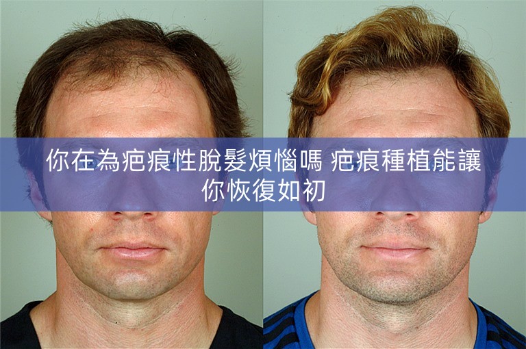 你在為疤痕性脫髮煩惱嗎 疤痕種植能讓你恢復如初