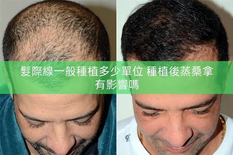 髮際線一般種植多少單位 種植後蒸桑拿有影響嗎