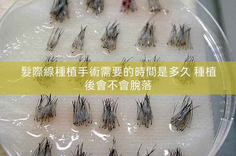 髮際線種植手術需要的時間是多久 種植後會不會脫落
