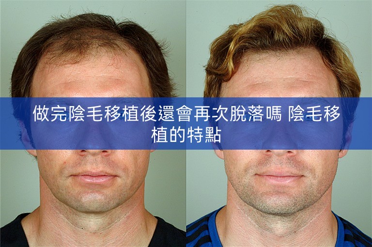 做完陰毛移植後還會再次脫落嗎 陰毛移植的特點
