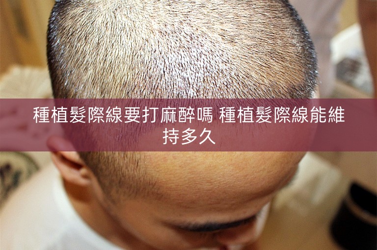 種植髮際線要打麻醉嗎 種植髮際線能維持多久