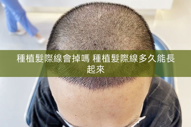 種植髮際線會掉嗎 種植髮際線多久能長起來