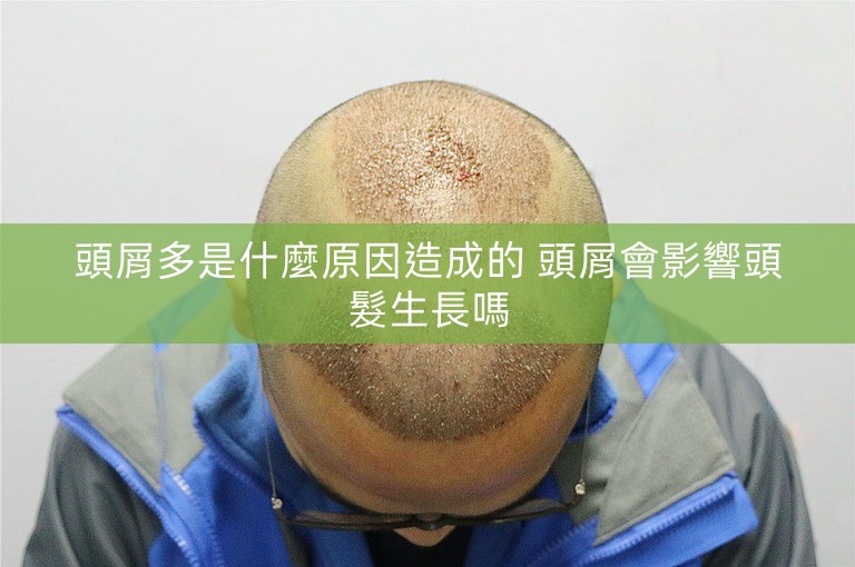 頭屑多是什麼原因造成的 頭屑會影響頭髮生長嗎